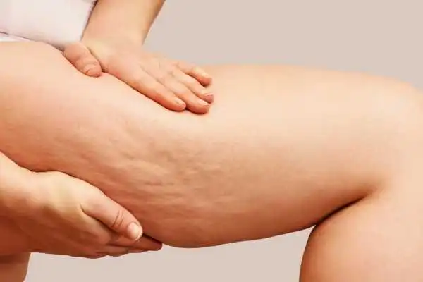 Image of woman showing leg with cellulite Chapel House