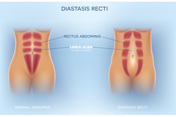 What Non-Surgical Options Are Available for Diastasis Recti Chapel House?