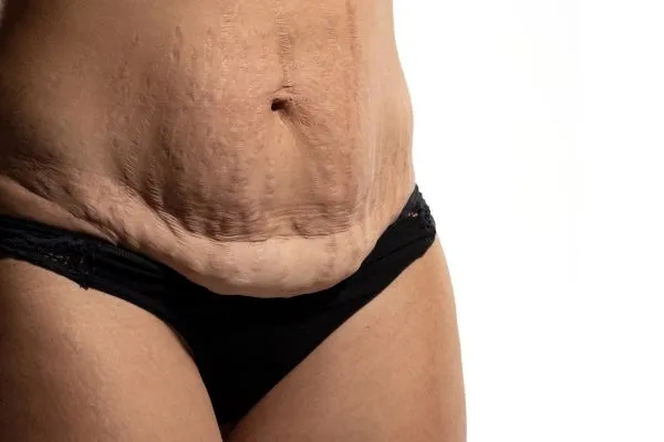 Image of womans stomach after weight loss injections Chapel House showing saggy skin